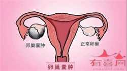 双侧输卵管伞部轻度积水做腹腔镜后北京代孕的